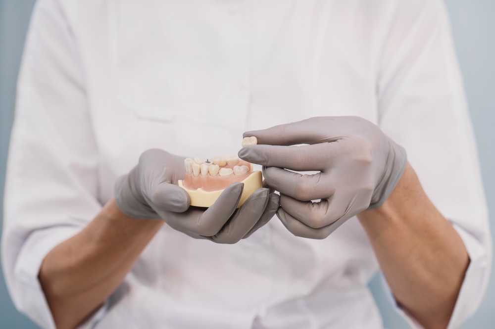 Close-up of a dental professional demonstrating dental crown placement using a tooth model, highlighting precision restorative care – Austin TX Dental Crowns
