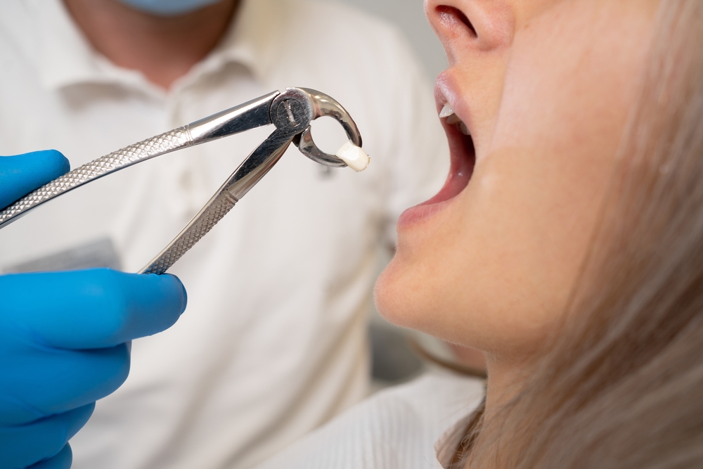 Close-up of a dental professional carefully removing a wisdom tooth, highlighting safe, precise, and effective oral surgery care – Wisdom Teeth Removal in Austin